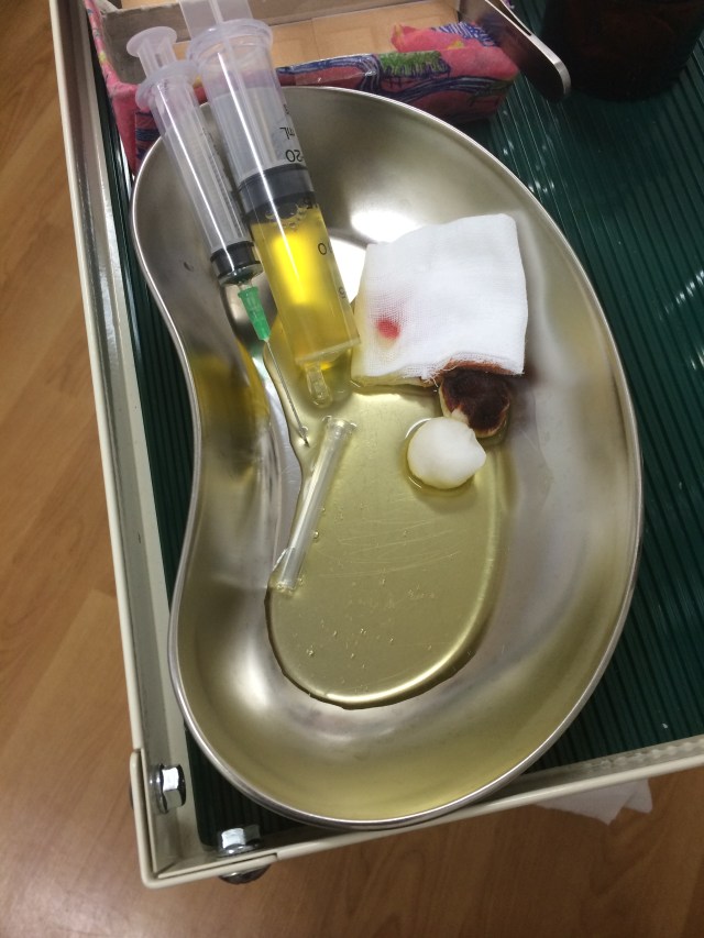 Three of those came out of my knee