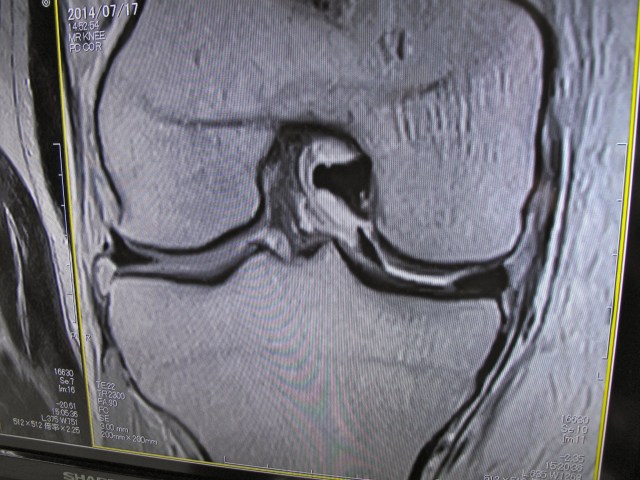 OK, this is a slice across my knee. in the gap between the two bones, on the right hand side, you can see two black areas. essentially they should be one such as you see on the left hand side of the gap. This indicates a bucket handle tear to the meniscus.