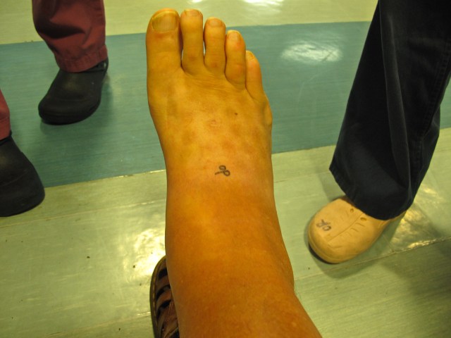 They write on the leg that has to be treated - just in case.